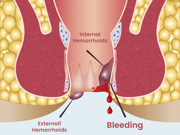 LOVILDS® Hemorrhoid Spray image LOVILDS® Hemorrhoid Spray